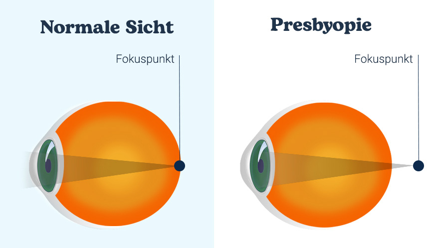 Abbildung des Fokuspunktes bei normalem Auge und bei Auge mit Presbyopie