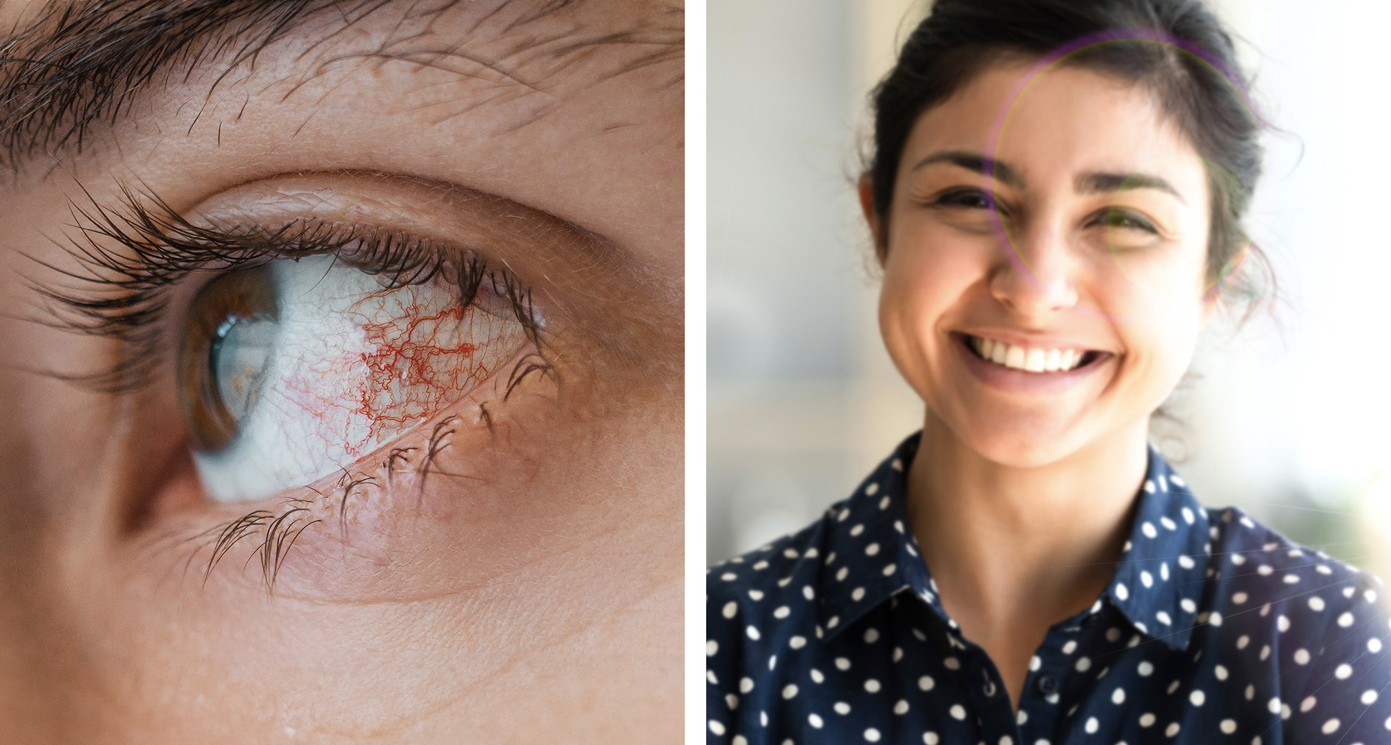 Photokeratitis might lead to red or bloodshot eyes (left). While not always the case, it can lead to blurry vision or symptoms like seeing halos in the visual field (right).