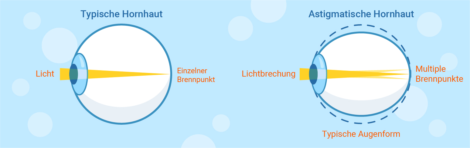 typical and astigmatism cornea